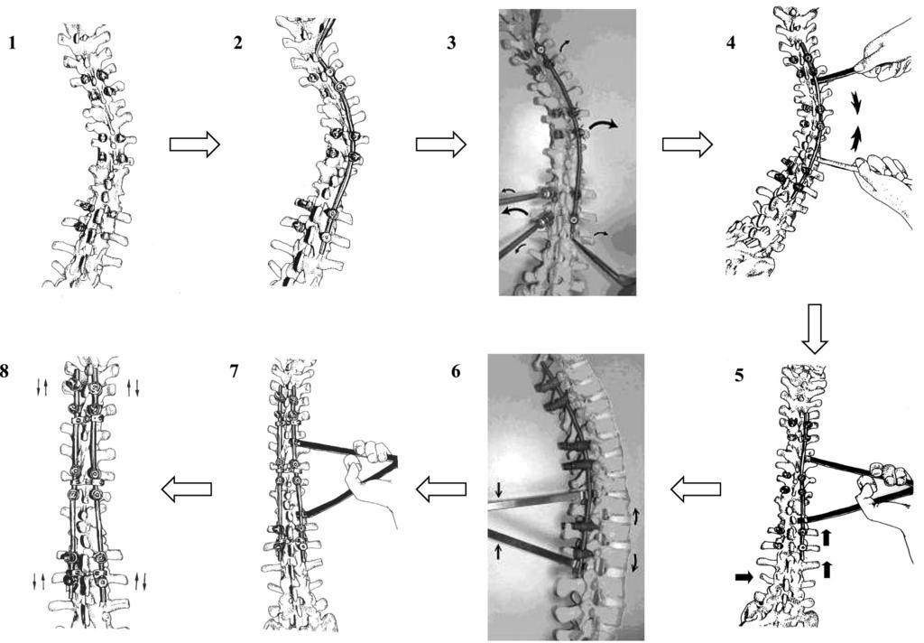 2 Spine Volume 32 Number 26 2007 Figure 1. Cantilever bending technique to provide controllable corrective forces for selective thoracic fusion.