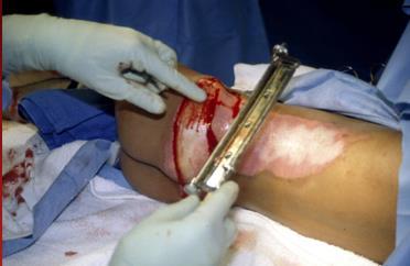 Early excision Patient s die from burn induced SIRS and SIRS related complications Excision of