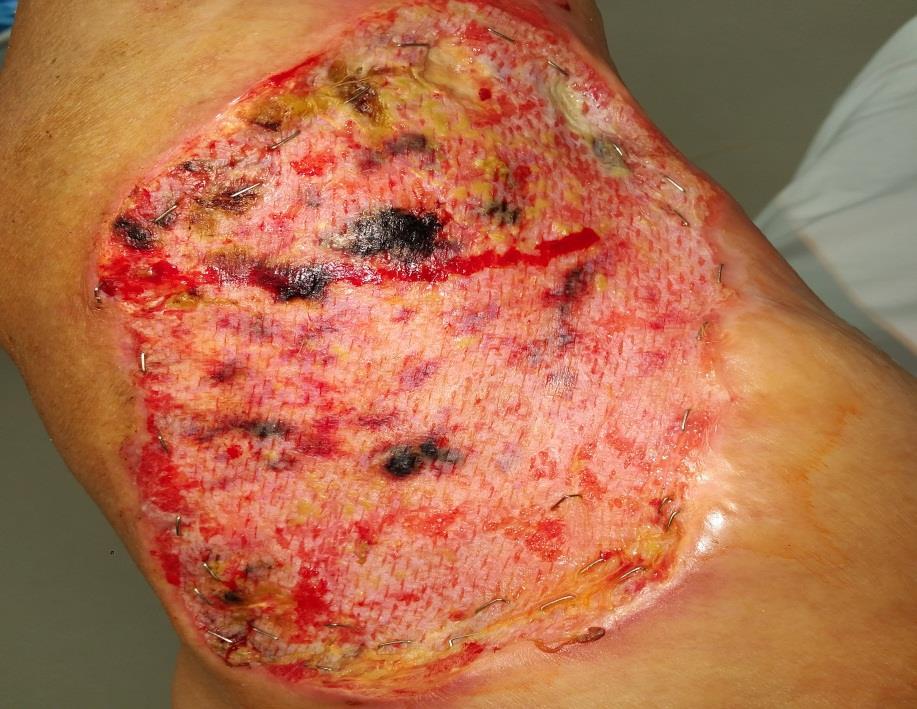 Xenograft Porcine skin (usually) Useful for temporary wound closure Primary