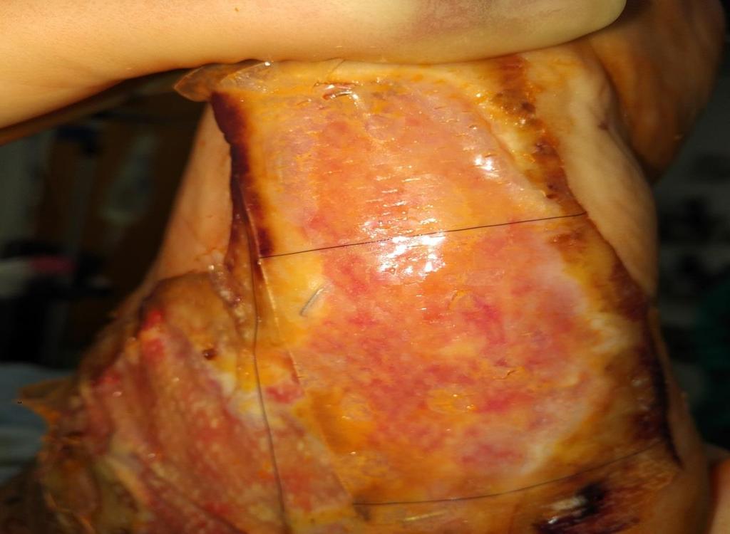 ligament, tendon Gives better turgor to STSG Cosmesis