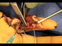 If you need to manipulate the tendon with instrument, touch the raw cut