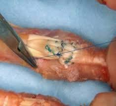 Flexor tendon repair At least 4 strand core repair with nonabsorbable suture Epitendinous in zone 2
