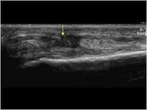 To evaluate for rupture Ultrasound Dynamic and includes attempted active motion Very dependent on the examiner!! After a previously repaired tendon ruptures: One Stage Repair 1. Minimal scarring 2.