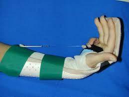significant flexion contractures Splinting Dynamic Night extension Casting