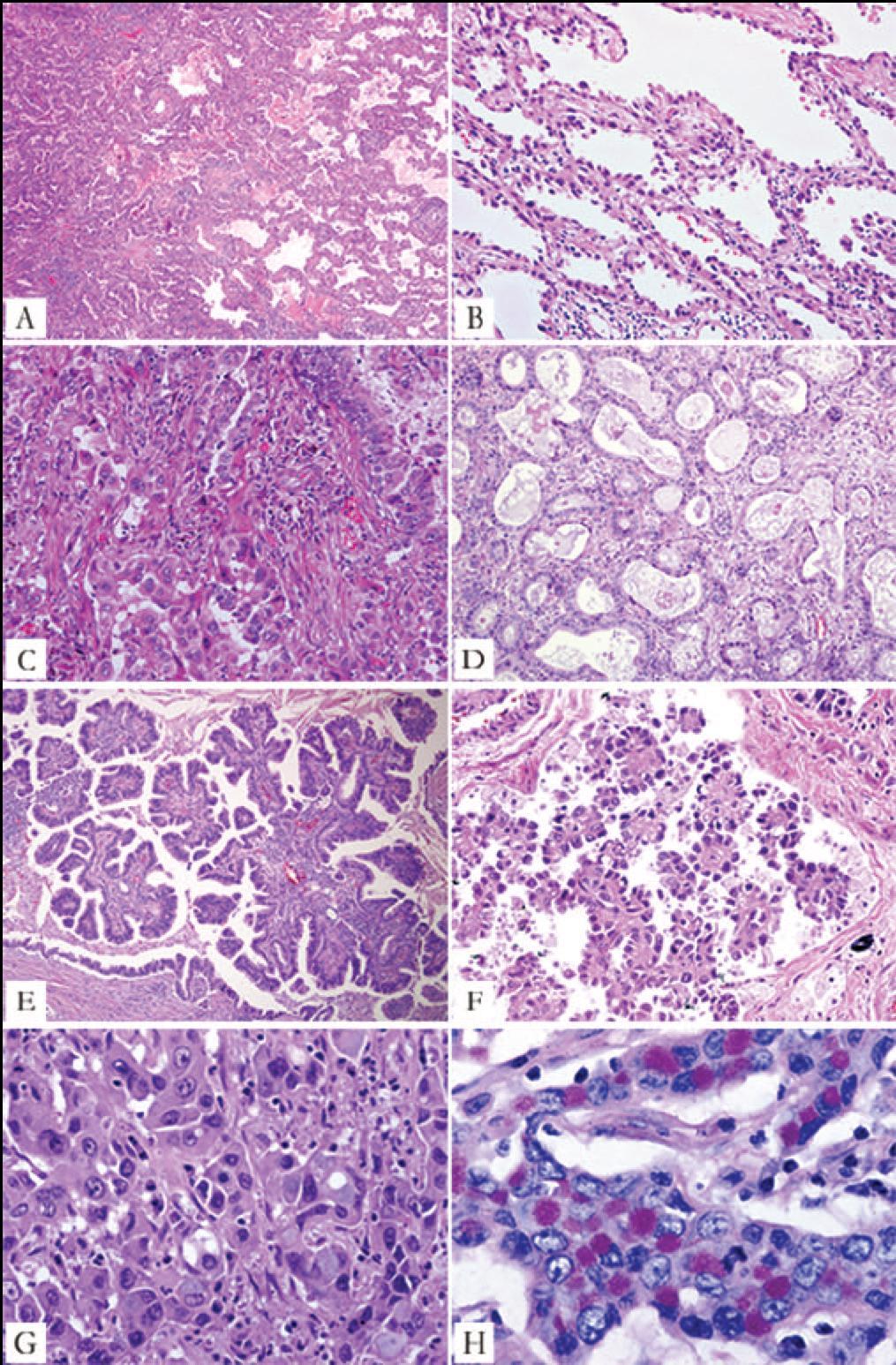 Lepidic predominant pattern Acinar adenocarcinoma Papillary adenocarcinoma Micropapillary