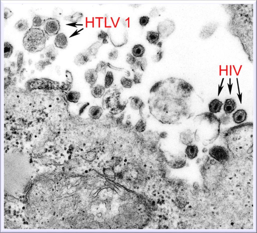 T cell co-infected with HTLV-1 and HIV (Feb.