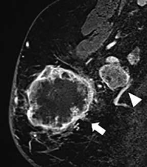 SOLITARY PANCREATIC METASTASIS FROM BREAST MATRIX-PRODUCING CARCINOMA KIYASU Fig. 1 Sagittal dynamic MRI images of the breast. Dynamic MRI of the breast tumor.