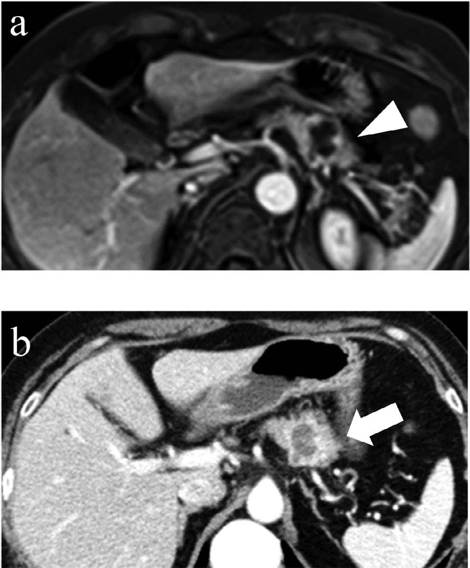 KIYASU SOLITARY PANCREATIC METASTASIS FROM BREAST MATRIX-PRODUCING CARCINOMA Fig. 3 Preoperative imaging study of the pancreatic tumor.