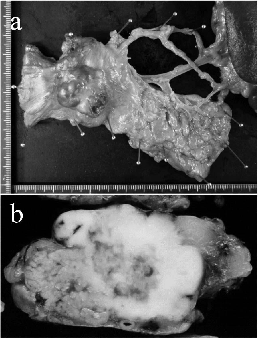 (b) Abdominal computed tomography revealed an irregular mass (white arrow) with small calcifications and ring enhancement. Fig. 4 Macroscopic finding of the pancreatic tumor. (a) Resected specimen.