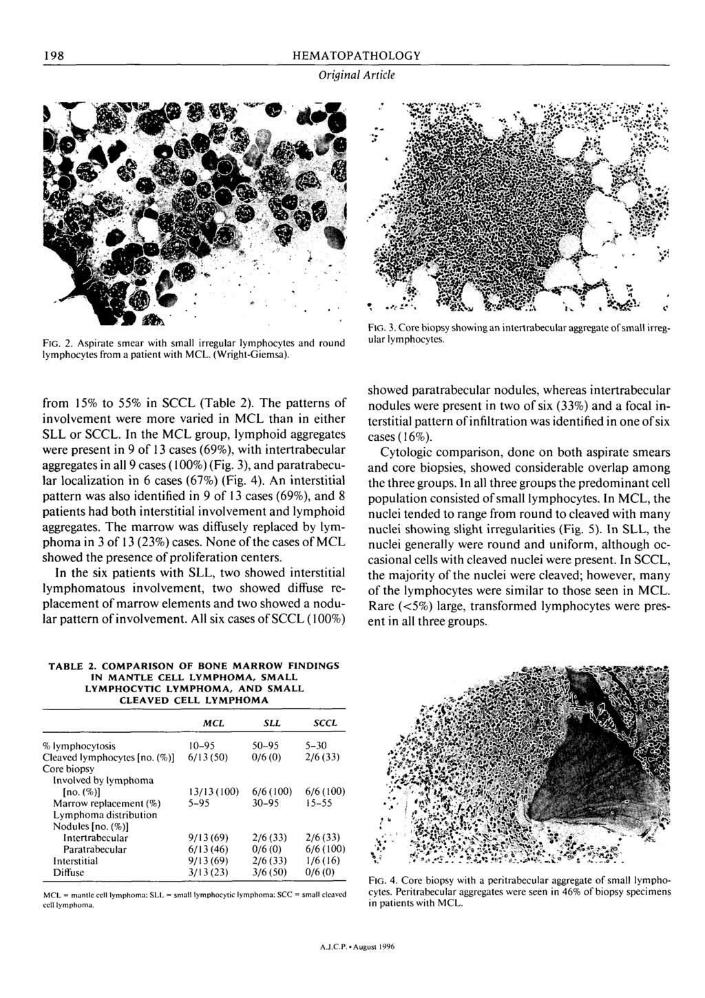 HEMATOPATHOLOGY 198 Origh Article from 15% to 55% in SCCL (Table 2). The patterns of involvement were more varied in MCL than in either SLL or SCCL.
