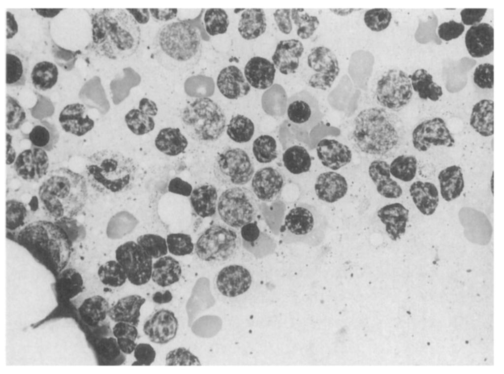 An interstitial pattern was also identified in 9 of 13 cases (69%), and 8 patients had both interstitial involvement and lymphoid aggregates.