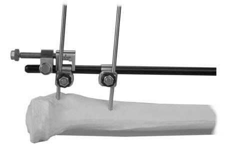 18 TransFx External Fixation System Large and Intermediate Surgical Technique 5.