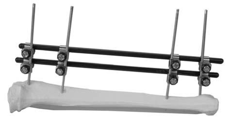 The pins are then connected through the use of multiple single-pin clamps and rods to achieve reduction and stability.