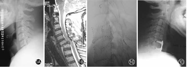 24 P. CAO ET AL. locked facet, 13 with facet or neural arch fractures; and seven, nine, five and two with C4 5, C5 6, C6 7 and C7 T1 fracture-dislocations, respectively).