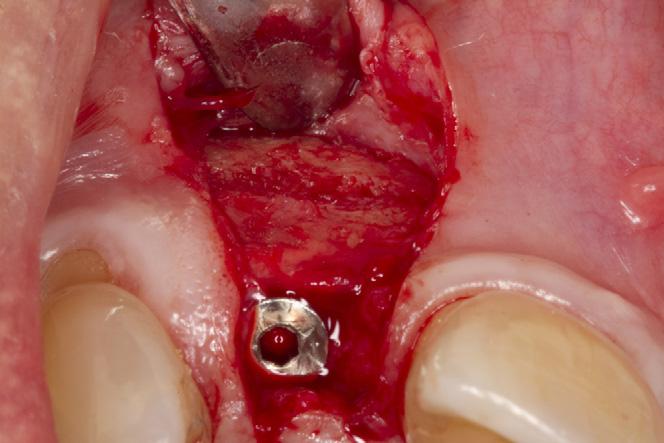Therefore, this case report aims at illustrating the ease and success of the sandwich bone augmentation technique when performed with dental implant placement.