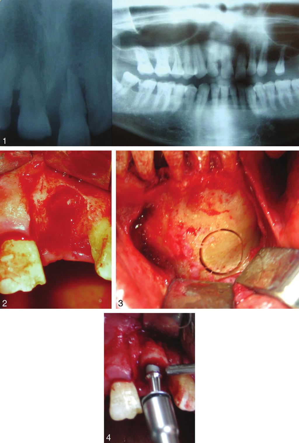 Tekin et al FIGURES 1 4. FIGURE 1. Preoperative radiographic view of the patient. Dramatic bone loss around tooth number 9. FIGURE 2. Vertical and horizontal bone deficiency after extraction.