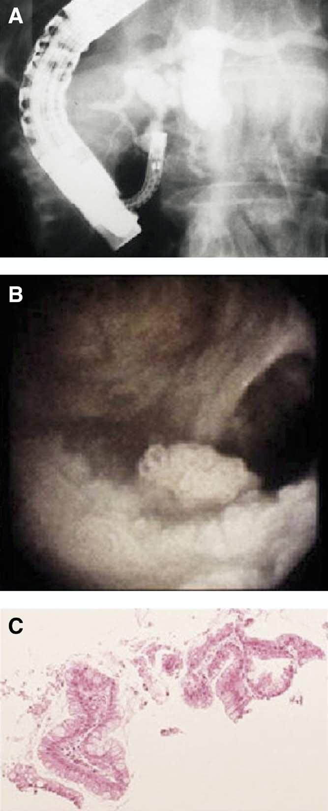 S56 YASUDA ET AL CLINICAL GASTROENTEROLOGY AND HEPATOLOGY Vol. 3, No. 7 Figure 2. A case of adenoma in IPMT.