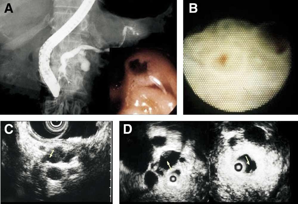 July Supplement 2005 PANCREATOSCOPY FOR PANCREATIC IPMT LESIONS S57 Figure 4. A case of adenoma in IPMT.