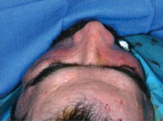 Brown et al. 349 Fig. 3 Endoscopic suturing of the malar fat pad to the temporalis to achieve a superolateral movement of the midface. (Reprinted with permission from Defatta and Ducic.