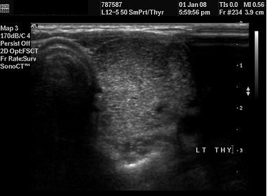 Figure4: Female 25 years old; bilateral diffuse thyroiditis (Hashimoto's disease). VI. conclusion Sonography is the single cost effective mean in detection of thyroid pathologies.