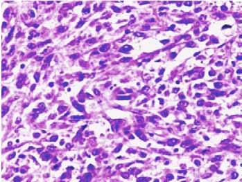 Safini et al. 33 Figure 4: A well-differentiated squamous cell carcinoma of the bladder (H&E stain, x200). natural history [1].