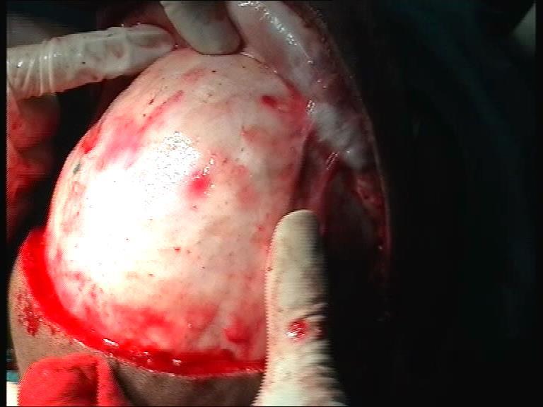 supraciliary incision Image