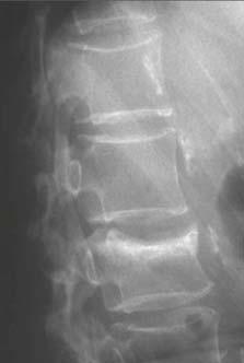 Calcitonin: Fracture Efficacy Minimal increase in spine BMD (1%) Unknown effects on non-vertebral fractures Caveats: high drop out rate, no dose-dependent response Chestnut, Am J Med 2000; Chestnut,