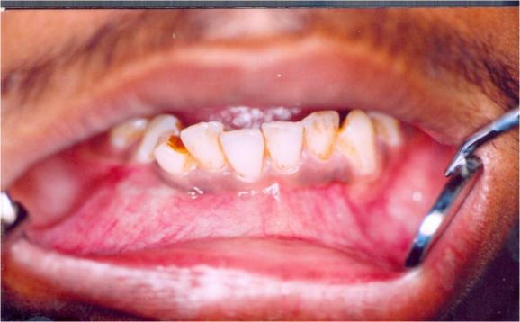 Figure 3: Intra-oral photograph showing lower labial