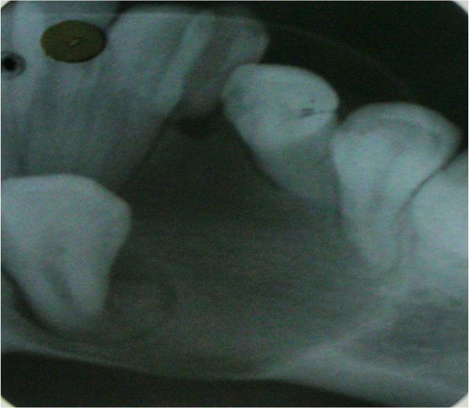 Periapical radiograph showing well defined radiolucency