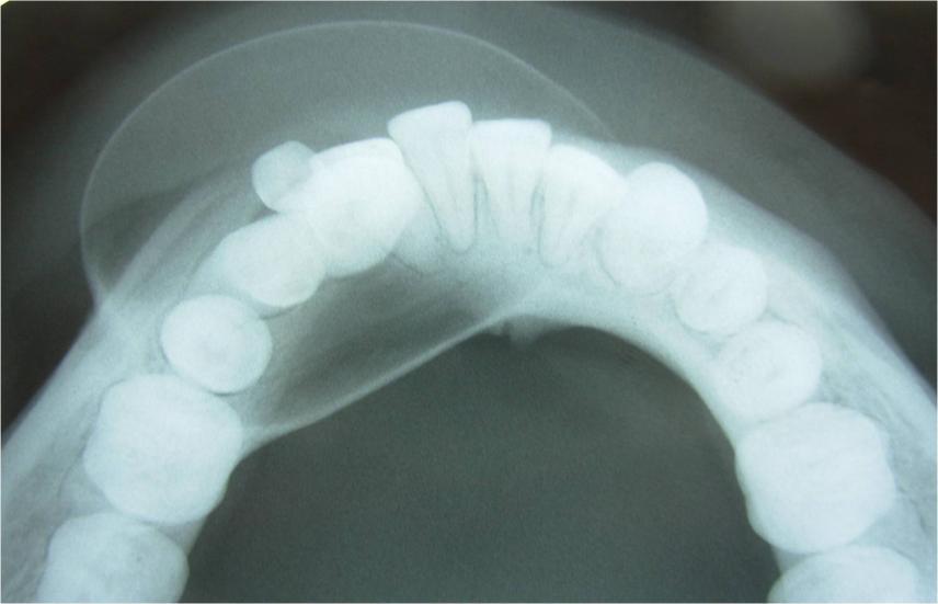Also notice displaced premolars Figure 5: Mandibular