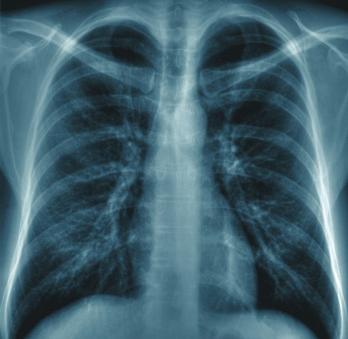 Tuberculosis Reported cases of tuberculosis (TB) decreased in 2014. Twenty-six cases of active TB were reported in Ramsey County, which is the fewest reported since 2000.
