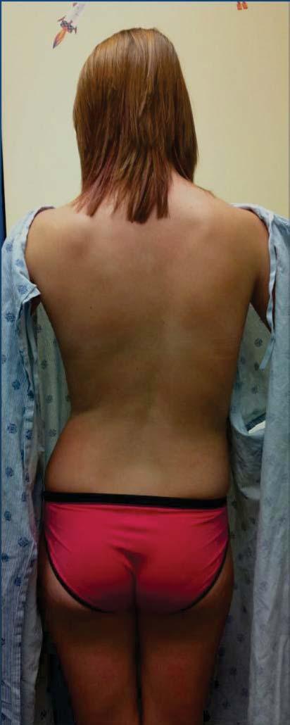 13 year old female presents with scoliosis Idiopathic Scoliosis Postmenarchal Curve has progressed