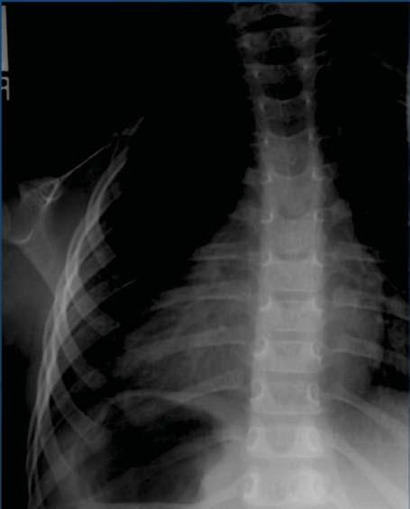 6 year old female presents with spinal curvature Congenital Scoliosis Stands with