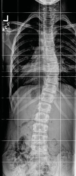 Other things to think about Congenital Scoliosis