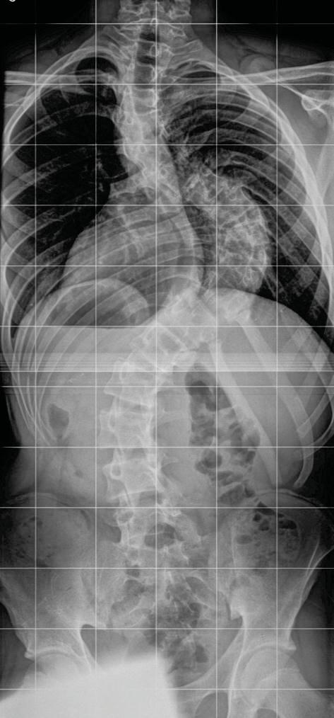 Types of Scoliosis -How imaging is used in each Plan for this talk What I am looking to learn from my