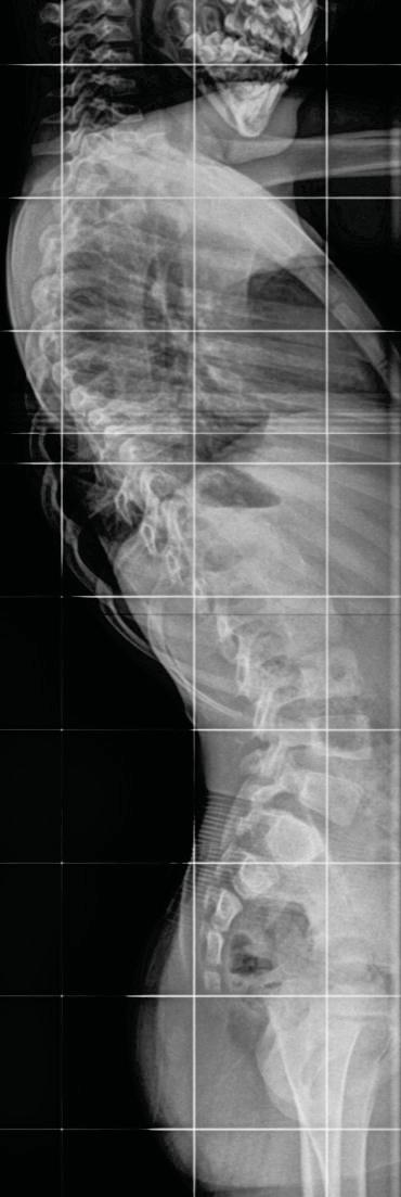 Scoliosis What I want to know: How big is