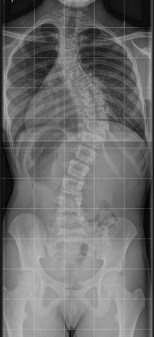 Plain radiographs Imaging in Scoliosis -Standing PA and lateral Entire spine on one film Entire pelvis visible