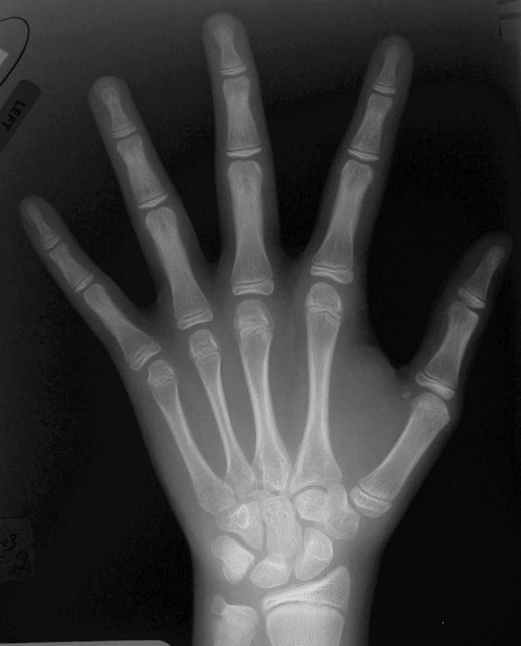 Hand Xray for
