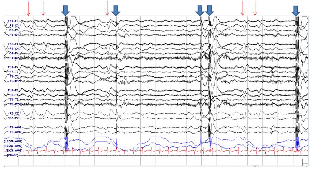 Seongheon Kim, et al. Recurred myoclonic SE in hypoxic encephalopathy after SSEP CASE A 77-year-old male was resuscitated after 6 minutes of respiratory arrest.