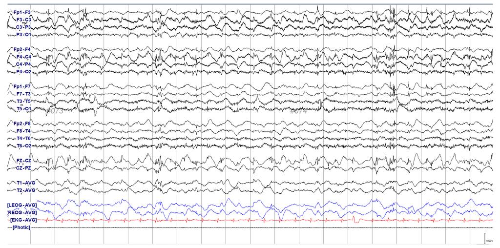 Annals of Clinical Neurophysiology Volume 19, Number 2, July 2017 Fig. 2. Electroencephalography (EEG) recorded at three days after hypoxic event.