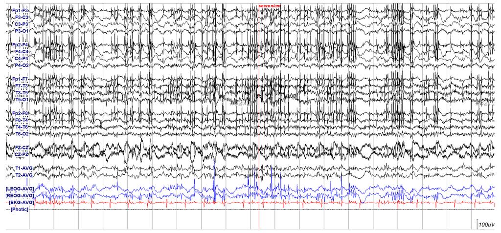 Seongheon Kim, et al. Recurred myoclonic SE in hypoxic encephalopathy after SSEP A B Fig. 3. Electroencephalography (EEG) after somatosensory evoked potential testing.