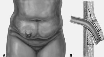 72 CLINICS IN COLON AND RECTAL SURGERY/VOLUME 21, NUMBER 1 2008 Figure 1 Redundant abdominal wall folds of skin associated with ileostomy retraction. (A) Frontal view.