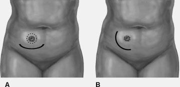 ABDOMINAL WALL MODIFICATION FOR THE DIFFICULT OSTOMY/BECK 73 Figure 5 Peristomal incisions outside area of appliance faceplate. (A) Inferior. (B) Lateral.