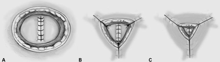 74 CLINICS IN COLON AND RECTAL SURGERY/VOLUME 21, NUMBER 1 2008 Figure 8 Mercedes or triangular closure.