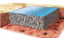Sealing Membrane A temporary, transparent polyurethane membrane designed to physiologically close the wound and limit evaporative water loss.
