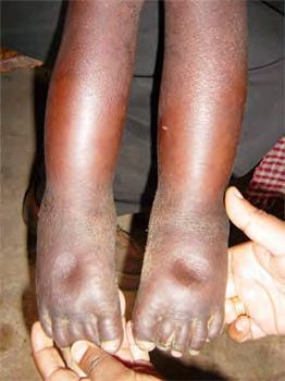 4. How to Assess for Bilateral Pitting Oedema Bilateral pitting oedema is swelling on both feet and legs. This is a clinical sign of acute malnutrition.