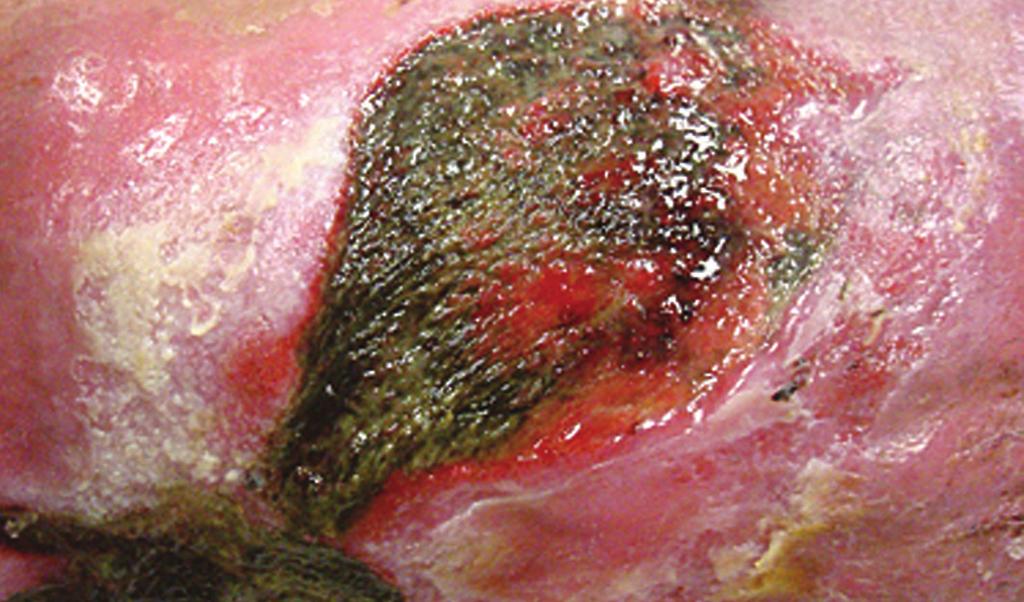 Hydroconductive Debridement with Drawtex Case Study (I) This wound on a 42-year-old male
