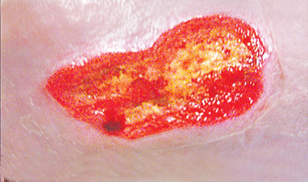 Case Study (II) This 72-year-old male exhibited a wound of mixed venous and arterial etiology.