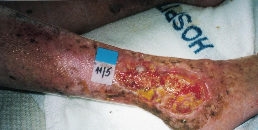 Case Study (III) This 68-year-old male presented with a venous ulcer that had been present for 35 years.