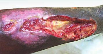 After 6 Days Case Study (IV) This female patient had developed a wound after her leg